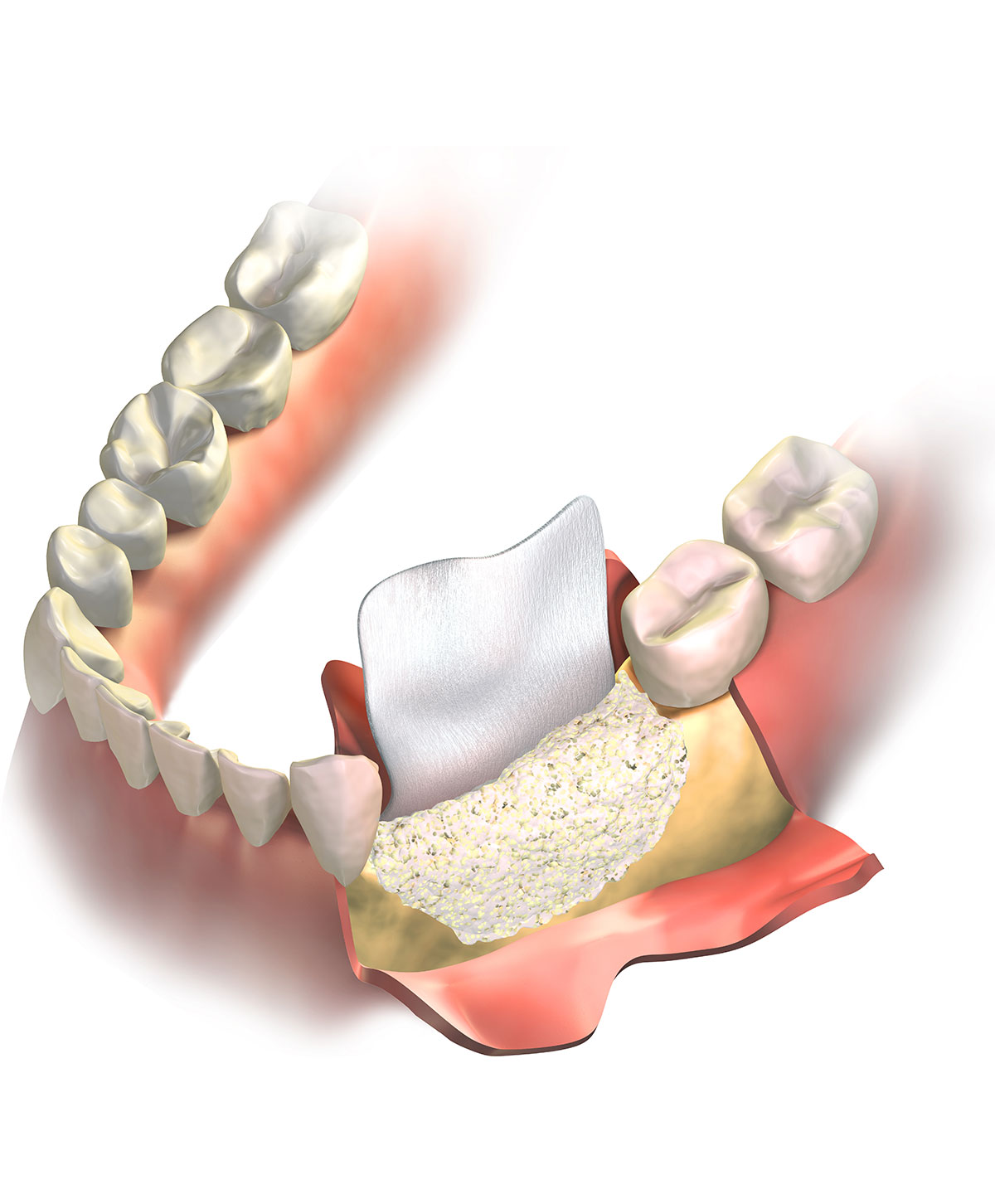 Render 3D Rigenerazione Ossea Denti